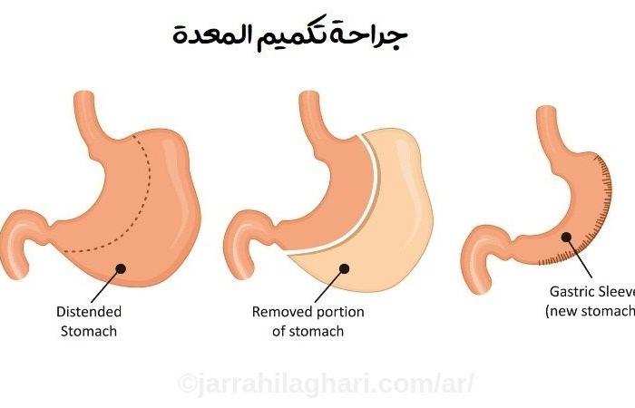 مميزات وعيوب تكميم المعدة