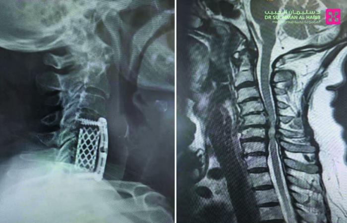 مركز جراحة المخ والأعصاب بمجمع الدكتور سليمان الحبيب بالعليا ينهي معاناة مسنة بعد جراحة استغرقت 4 ساعات