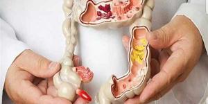 منها السمنة .. أمراض تزيد خطر الإصابة بسرطان القولون