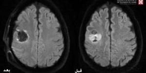 مستشفى الدكتور سليمان الحبيب بالريان ينجح في استئصال ورم بالدماغ باستخدام جهاز الملاحة العصبية