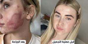 عملية تجميل تنتهي بتشوه دائم لبريطانية