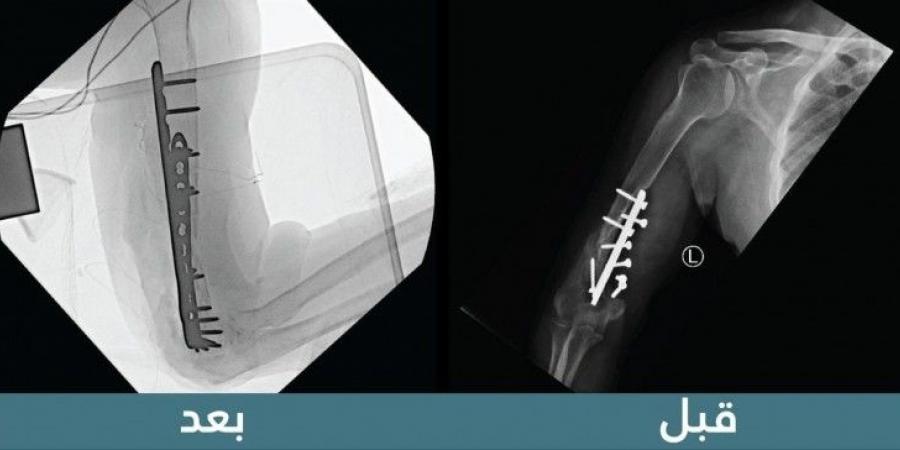 "سعود الطبية" تنهي معاناة مريض خمسيني من فقدان حركة الكوع استمرت 19 عامًا