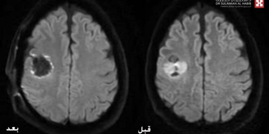 مستشفى الدكتور سليمان الحبيب بالريان ينجح في استئصال ورم بالدماغ باستخدام جهاز الملاحة العصبية